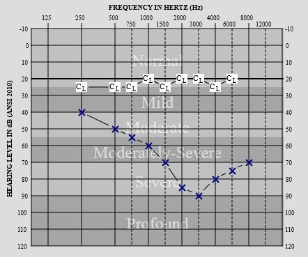 Andy Torres’ audiogram (a graph representing frequencies heard by a person in decibels and hertz, as measured by an audiometer). Blue X’s slope downward, indicating Andy’s limited hearing sensitivity in his left ear with a hearing aid alone. White squares marked “CL” are plotted in a horizontal line, representing Andy’s improved hearing in his left ear now with his cochlear implant. 