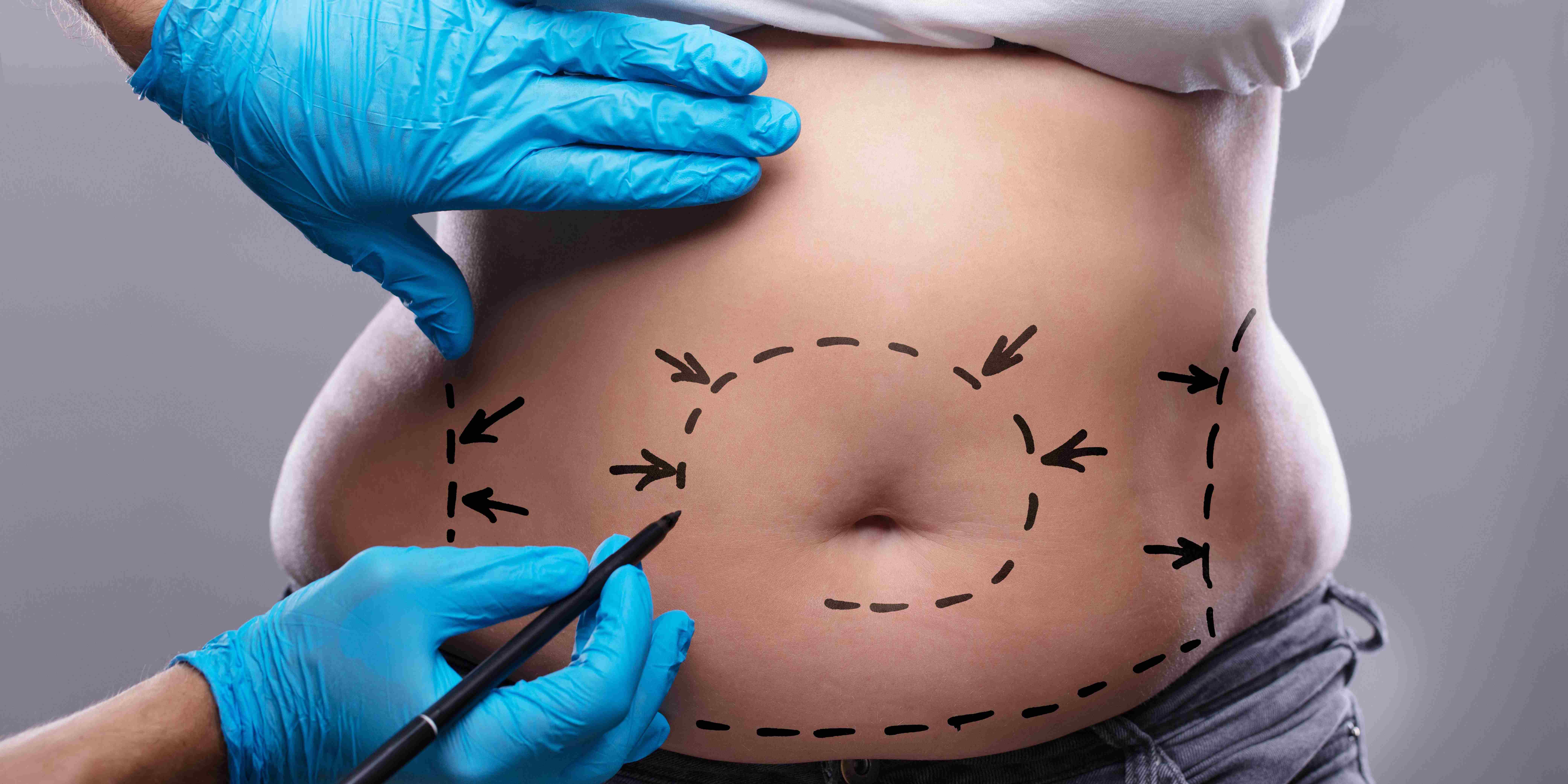 What Can a Tummy Tuck Address? What Can It Not?