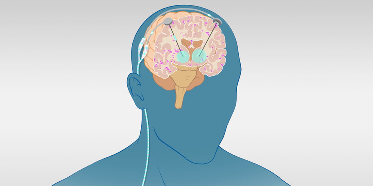 A medical illustration of a deep brain stimulator inside the brain 