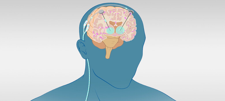 What You Need to Know About Deep Brain Stimulation for Epilepsy