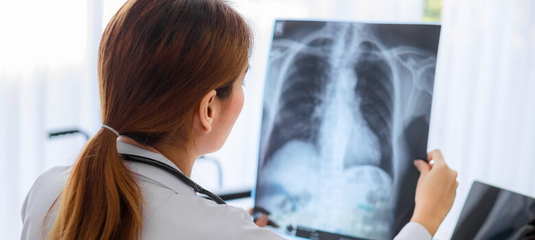 Lung Cancer in Young and Middle-Aged Women Is On the Rise