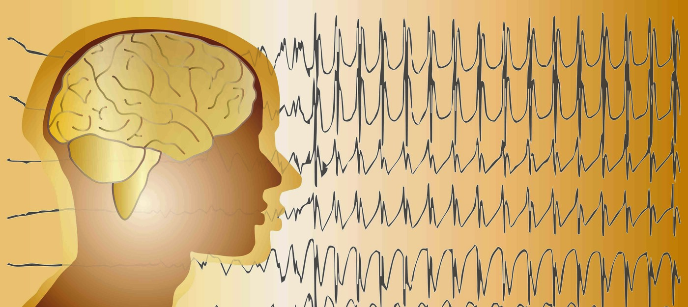 Robot Reduces Need for Open Brain Surgery to Map Epileptic Seizures